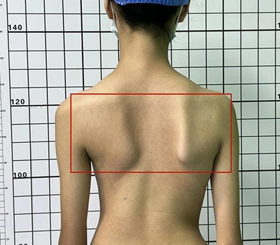 Átfogó scoliosis felmérés: A gerinc egészségének megértése, azonosítása és kezelése