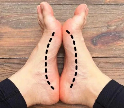 High Arch Assessment: klinikai módszerek, ívindex értékelés és kereskedelmi alkalmazások a láb eg...