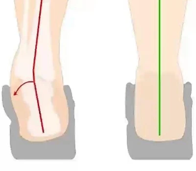 Sarokváltoztatás és sarokfordítás értékelés: Klinikai értékelés, gyakorlati alkalmazások és keres...