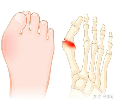 Hallux Valgus: Teljes tudományos útmutató