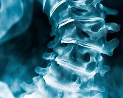 AI gerincferdülés szűrés és gerincigazítás nyomon követése: Okosabb 3D egészségügyi szűrési megol...