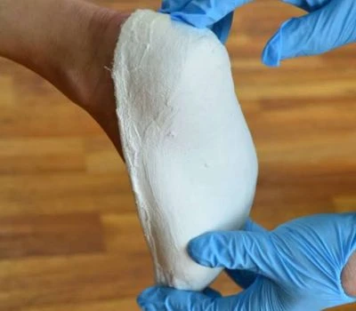 Hogyan alakítják át a 3D lábszkennerek az ortopédiai támogató eszközök jövőjét?
