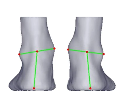 Heel -valgus és varus: néma fenyegetés