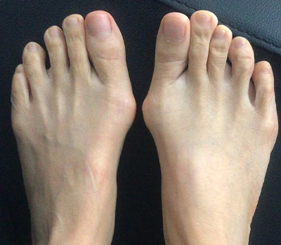 A Hallux Valgus mérése: Miért haladnak túl a 3D -s szkennerek a klinikusok és a kórházak túllépése