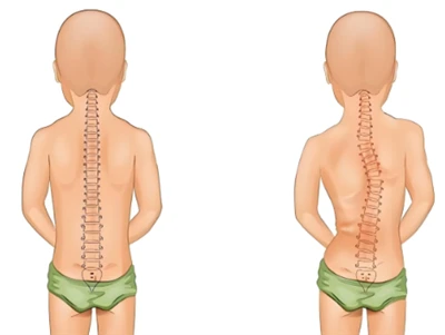 Új scoliosis szűrési módszer: AI és 3D digitális gerinc