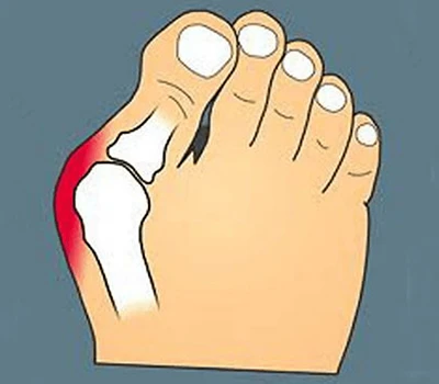 Transforming Bunion Care: A precíziós szkennelés integrálása a fokozott testreszabás, a betegek b...